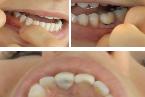 bulimic-teeth (1)